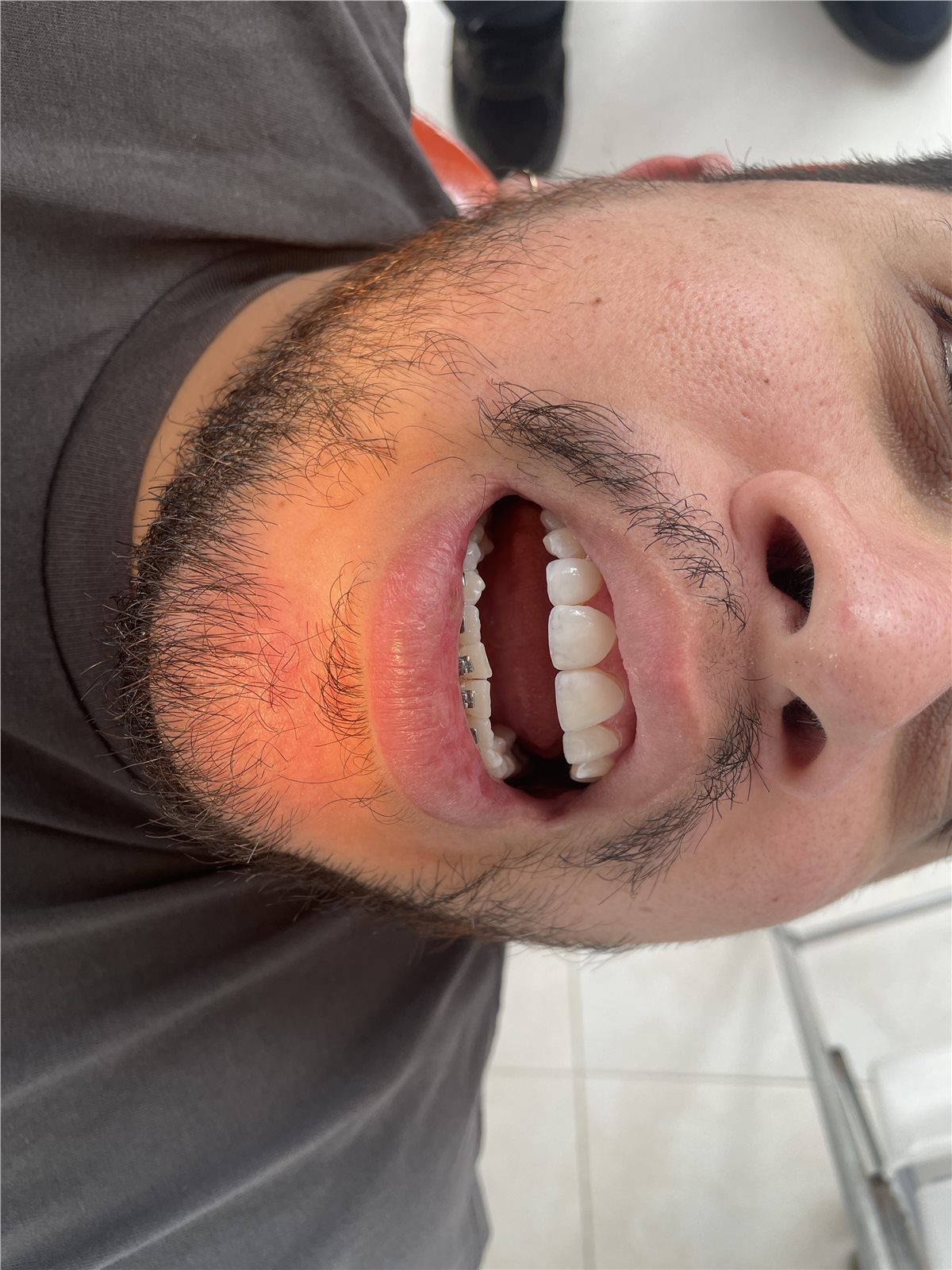 Patient 1 after porcelain smile design close view