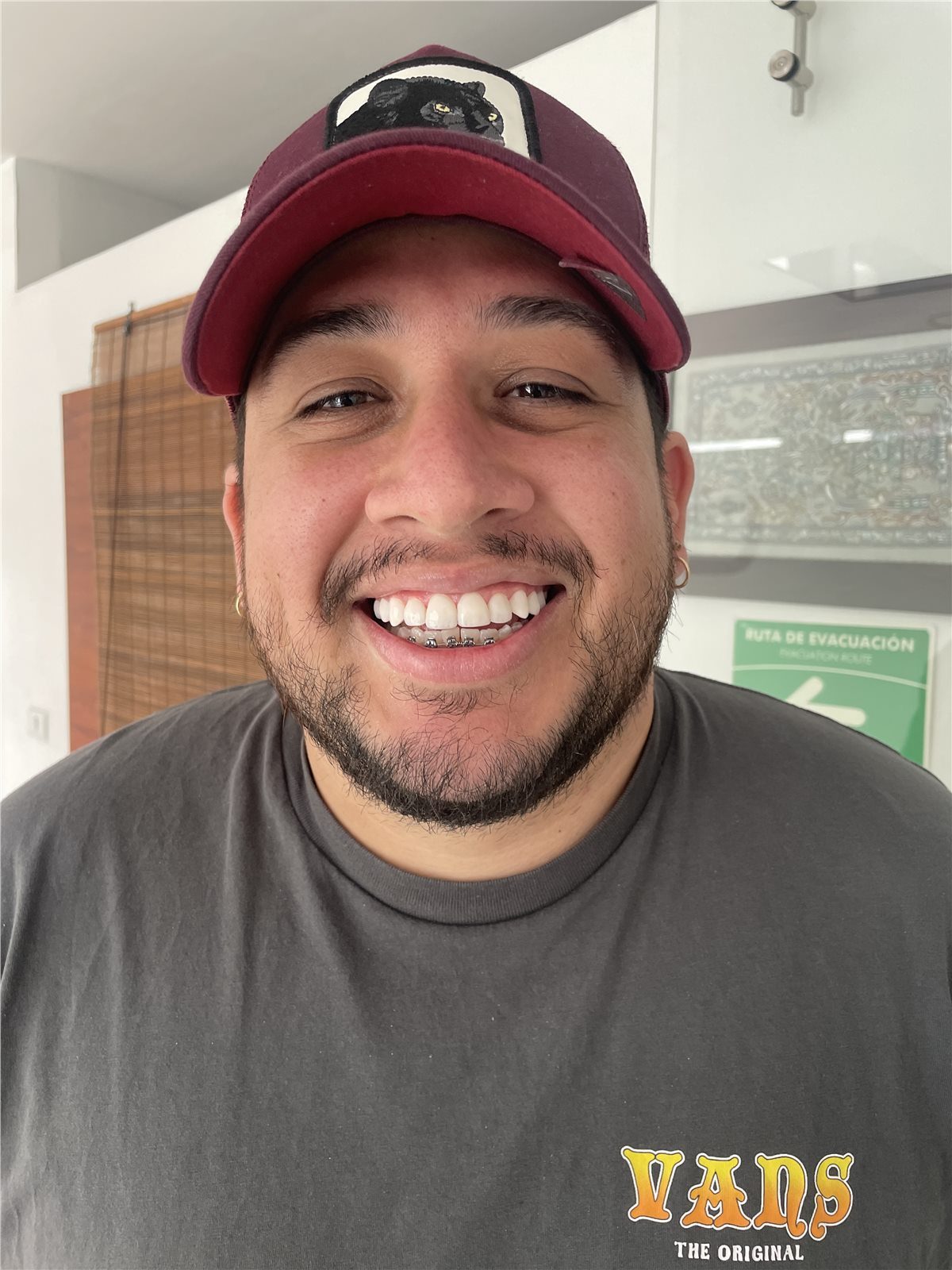 Patient 1 after porcelain smile design smiling view