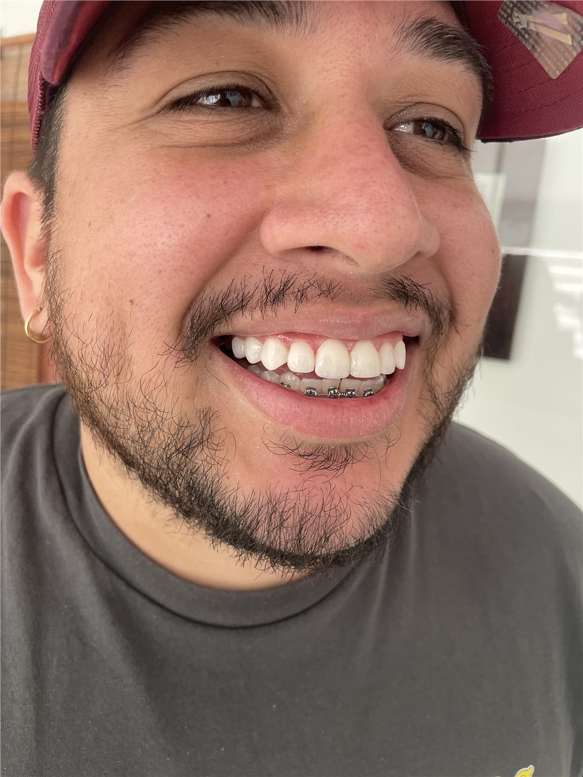 Patient 1 after porcelain smile design side smile