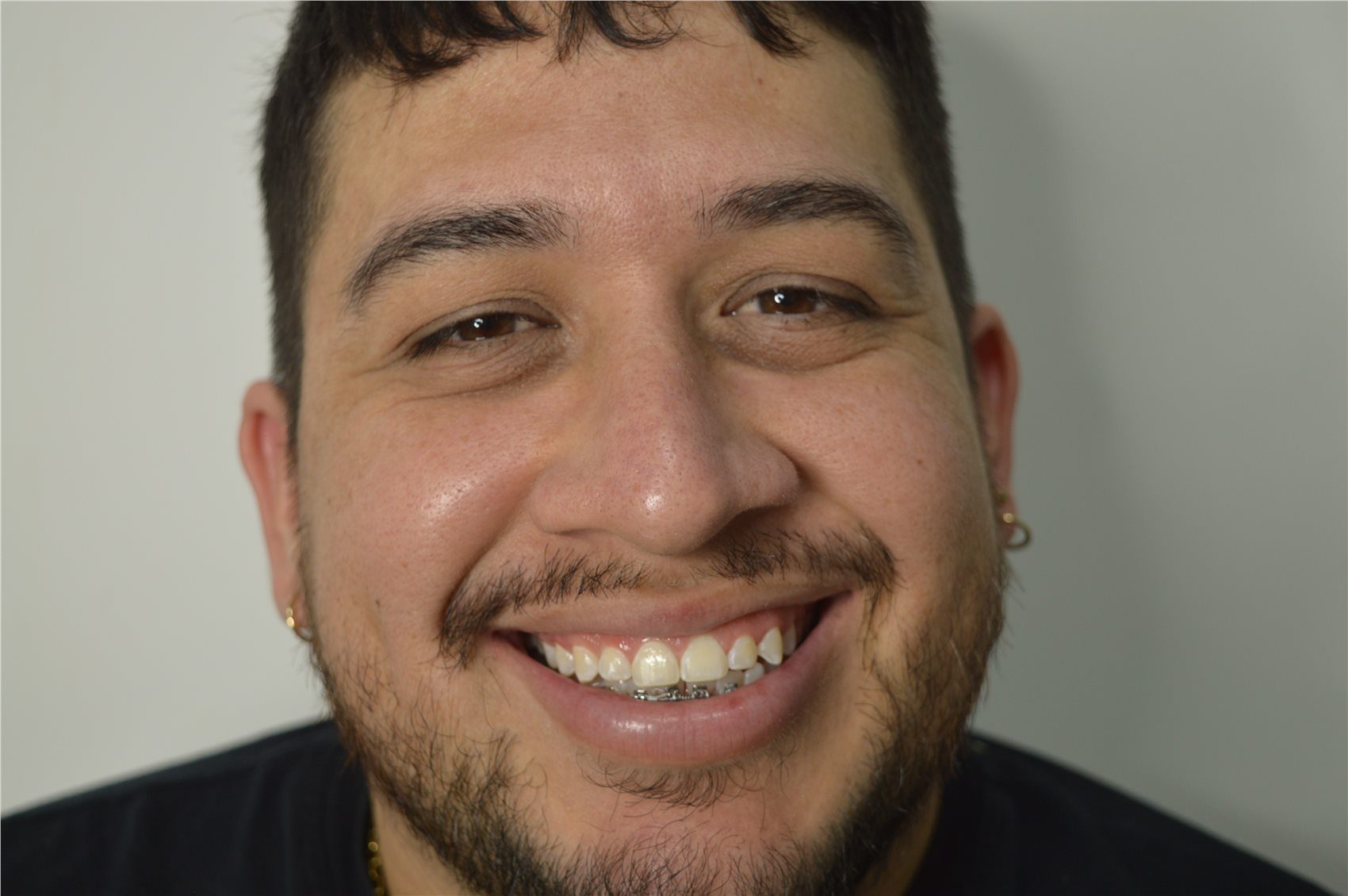 Patient 1 before porcelain smile design close view