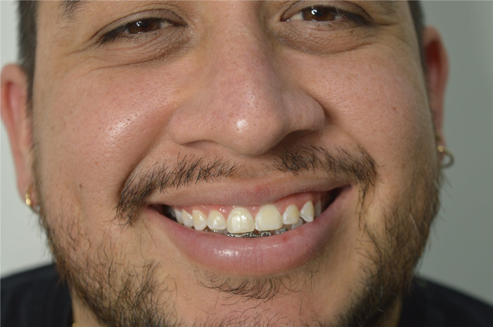Patient 1 before porcelain smile design additional close view