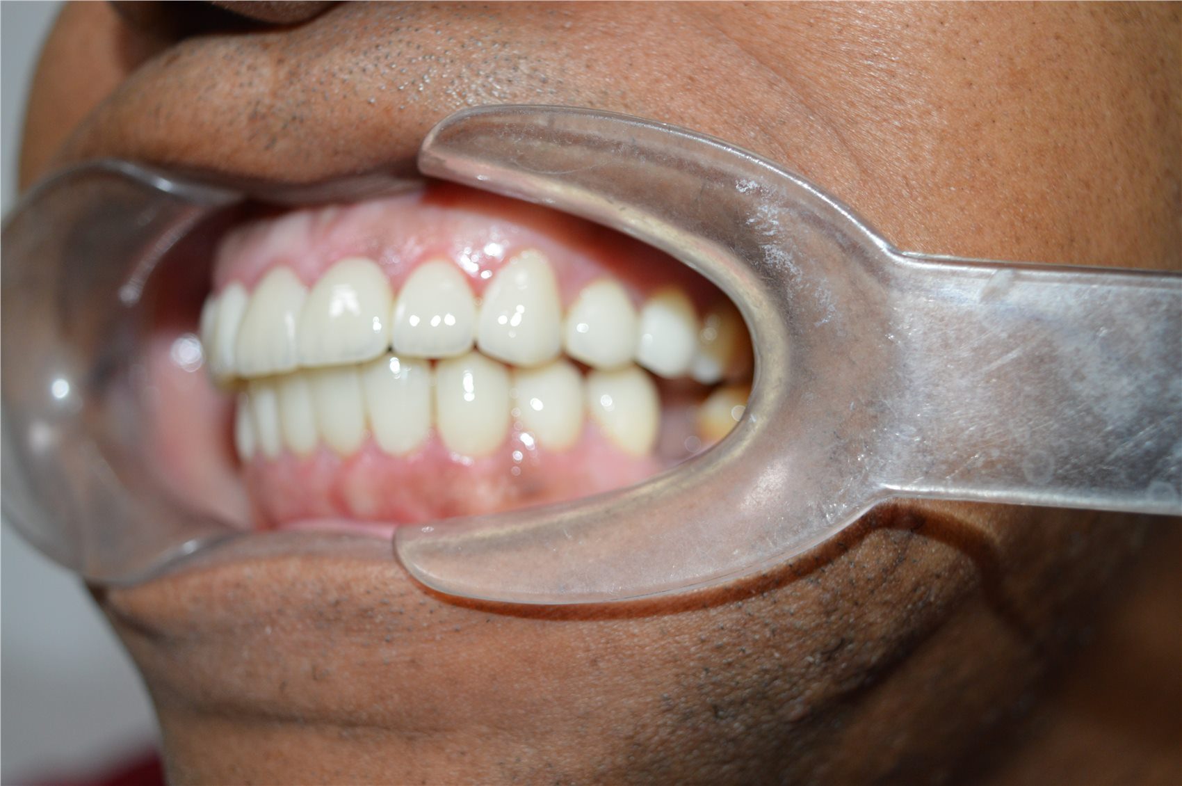 Patient 2 after porcelain smile design side clinical view
