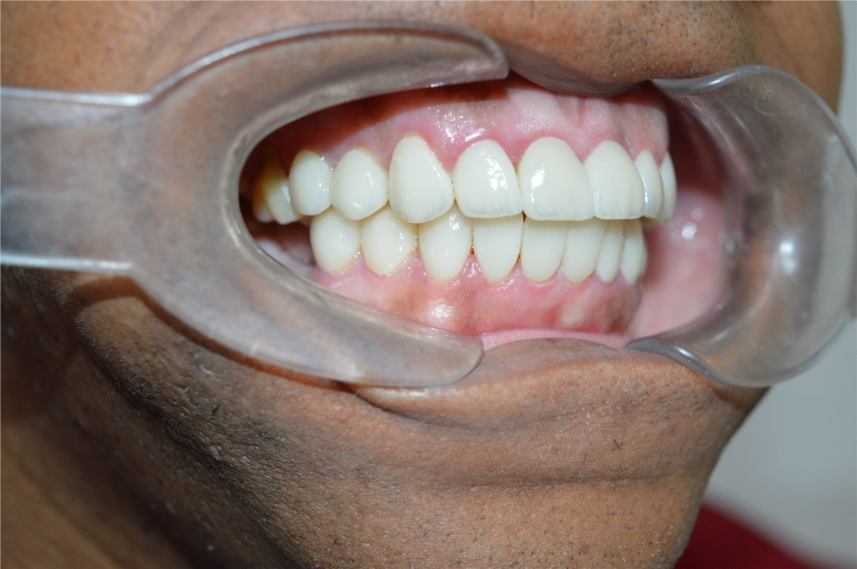 Patient 2 after porcelain smile design side view