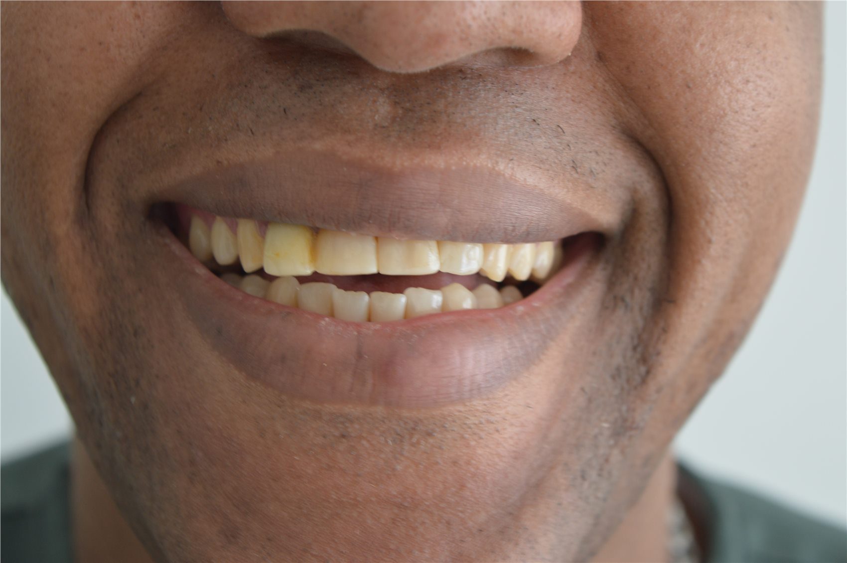 Patient 2 before porcelain smile design smiling view