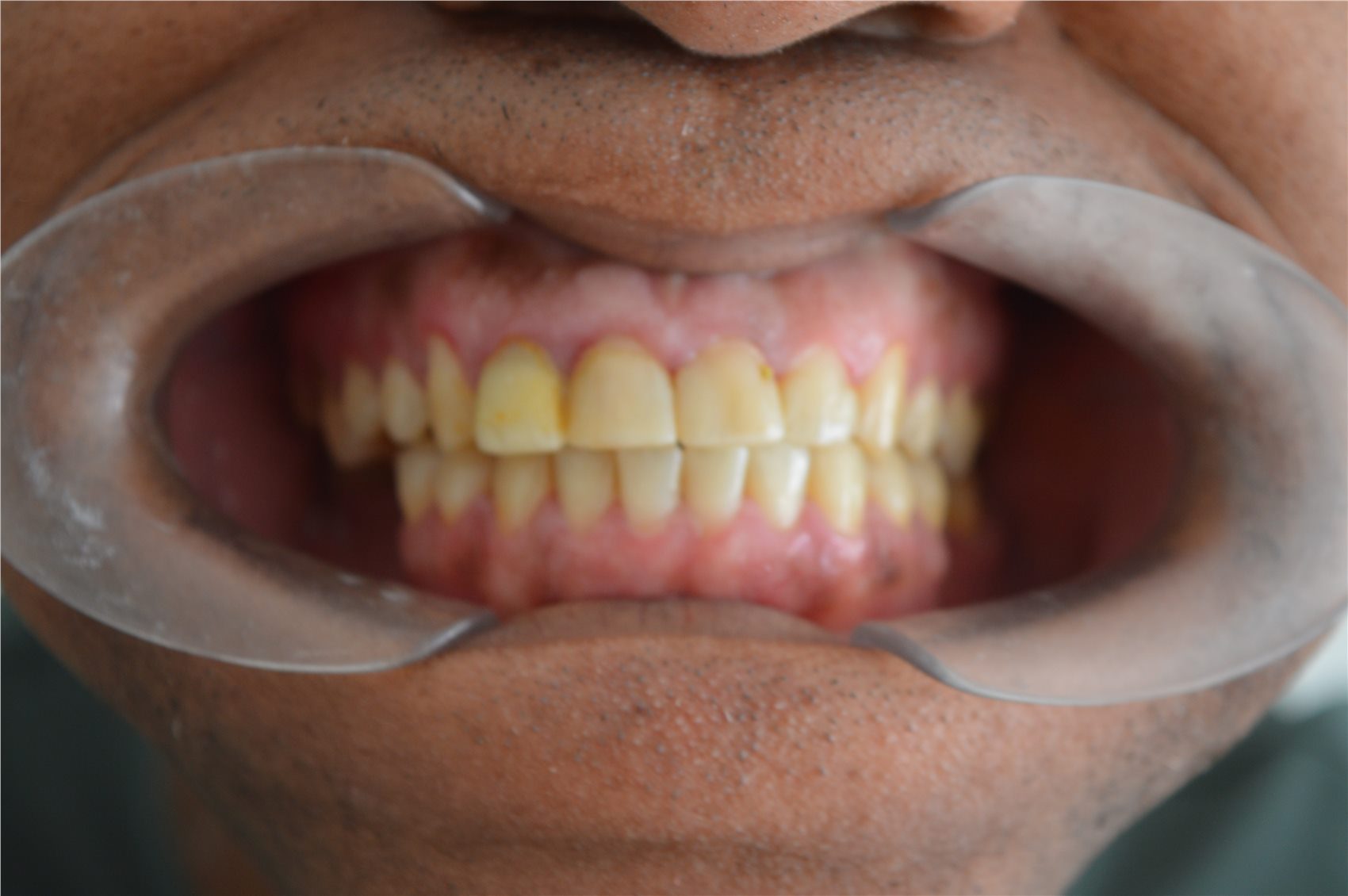 Patient 2 before porcelain smile design frontal clinical view