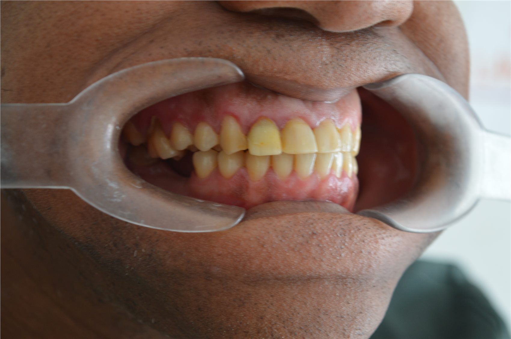 Patient 2 before porcelain smile design profile view